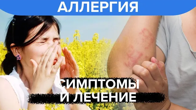 Аллергия: симптомы и лечение аллергии смотреть онлайн