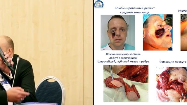 Хирургические аспекты реабилитации больных с опухолями головы и шеи смотреть онлайн