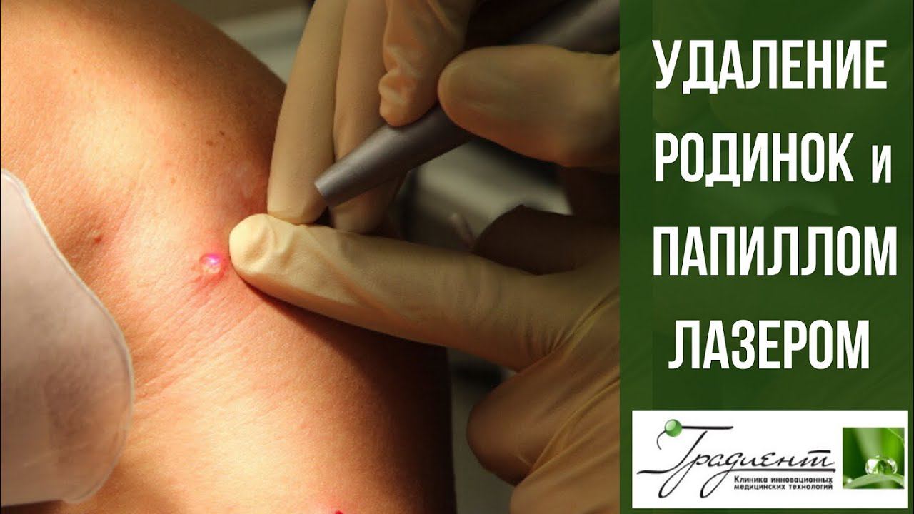 УДАЛЕНИЕ РОДИНОК и ПАПИЛЛОМ ЛАЗЕРОМ - в клинике "Градиент. Врач: Ганьшин Вячеслав Павлович. смотреть онлайн