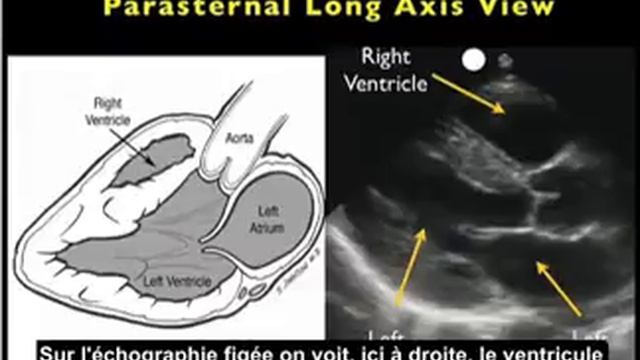 Comment : Réaliser une échographie cardiaque : vue parasternale grand axe, 1ère partie смотреть онлайн