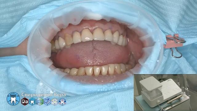 Professional oral hygiene -case 009 Acteon DTE Dentsply Coxo Floweis 3M KerrHawe (FHD multistream) смотреть онлайн