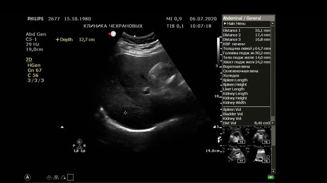 УЗИ органов брюшной полости и почек в Уссурийске , клиника Чехрановых 2020 07 06 09 55 17 смотреть онлайн