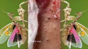 Relax squeezing out blackheads #41 Черные точки