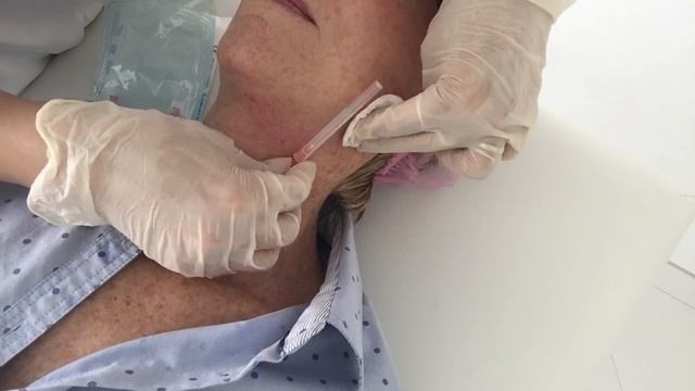 3D LIFTING-PDO HILOS