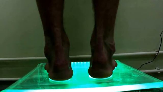 Варус стопы, ортопедические стельки Ижевск