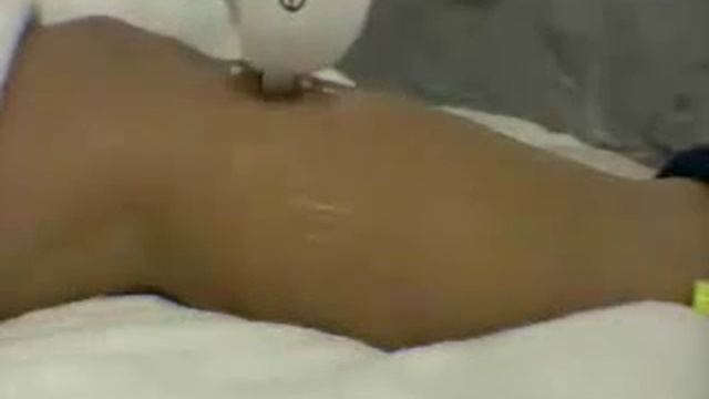 Depilacja laserowa cz2 смотреть онлайн