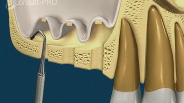 Sinus Lift Internal With 3 Implants | Implants Pro Center© | San Francisco