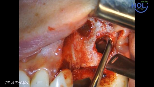 Открытый синус-лифтинг и имплантация при наличии септы смотреть онлайн