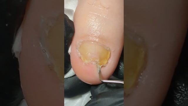 Онихогрифоз 1 часть смотреть онлайн