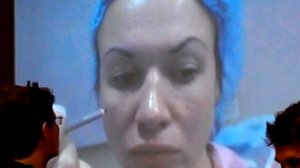 Скулы мастер класс филлеры REVOFIL ( ч. 1 )