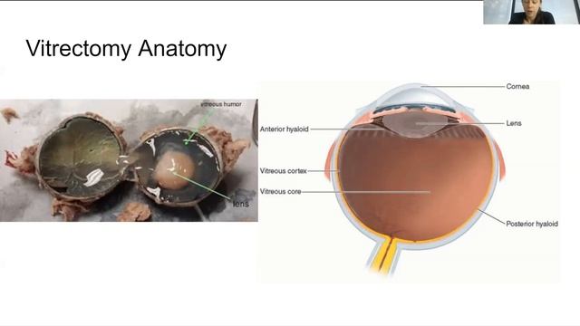 Ophthalmic Surgery Lecture Part 2 смотреть онлайн