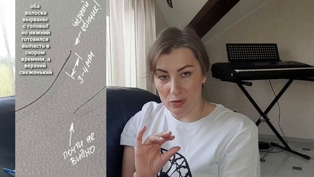 #ВОЛОСАТЫЕ ИСТОРИИ|ОТВЕТЫ ВРАЧА | ВЫПАДЕНИЕ ВОЛОС| МИНОКСИДИЛ ИЛИ ФИНАСТЕРИД| пересадка волос смотреть онлайн