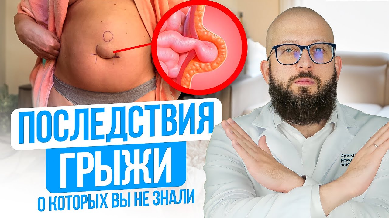 ПОСЛЕДСТВИЯ ПУПОЧНОЙ ГРЫЖИ о которых молчат доктора. Современные методы лечения пупочной грыжи смотреть онлайн