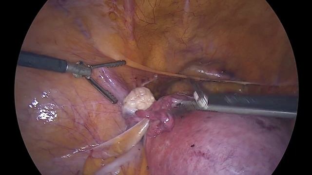 экстирпация матки // лапароскопическая гистерэктомия // TLH смотреть онлайн