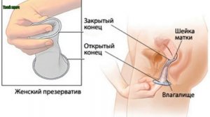 ЖЕНСКИЙ  ПРЕЗЕРВАТИВ