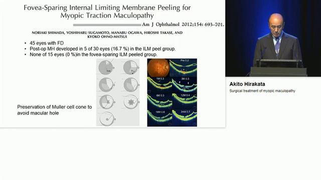 Surgical treatment of myopic maculopathy Hirakata Akito смотреть онлайн