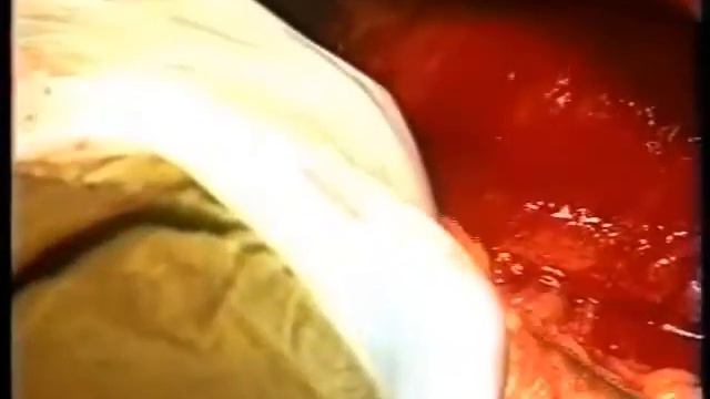 Расширенная субтотальная дистальная резекция желудка смотреть онлайн