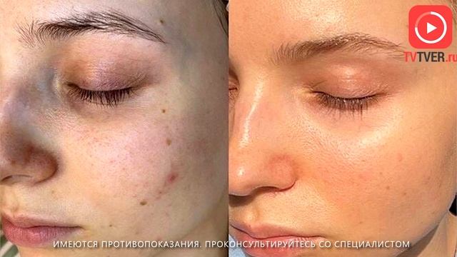 В Cicada Сlinic назвали любимую процедуру 2022 года и представили хит аппаратной косметологии