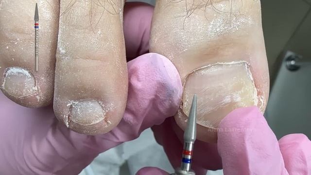 Мужской педикюр / Странный налет на ногтях / смотреть онлайн