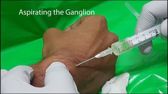 #Ganglion Cyst#Dr Lenin Babu#OrthopaedicSurgeon#KMCH#Coimbatore смотреть онлайн
