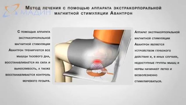 Авантрон - аппарат экстракорпоральной стимуляции органов малого таза смотреть онлайн