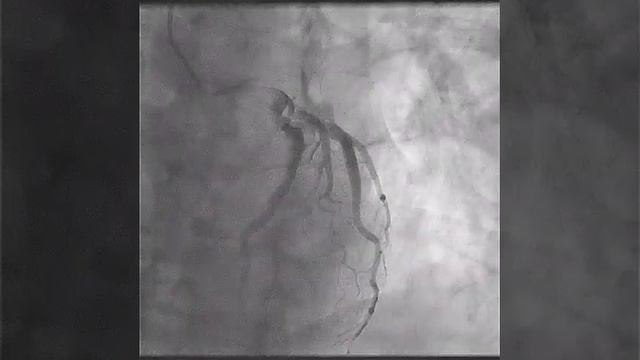 Coronary Angiography Part 2 смотреть онлайн
