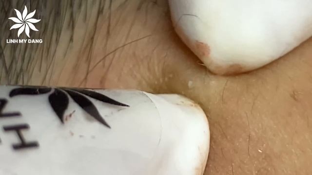 Relaxing Acne Treatment #22 | Girl Acnes смотреть онлайн