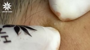 Relaxing Acne Treatment #22 | Girl Acnes