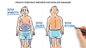 Техника инъекций. Как правильно делать инъекцию инсулина?