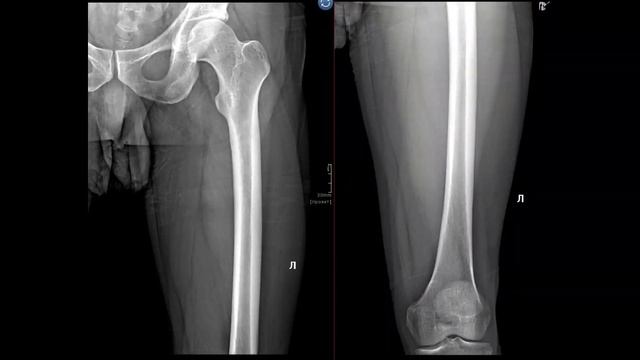 Укладка бедренной кости смотреть онлайн