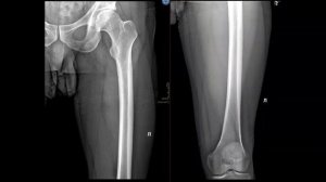 Укладка бедренной кости