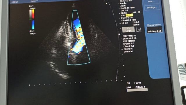 Динамическая обструкция выносящего тракта левого желудочка смотреть онлайн