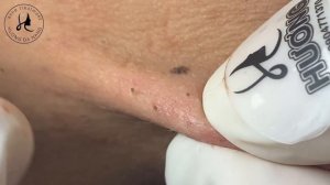 Huong Da Nang Acne Treatment #355