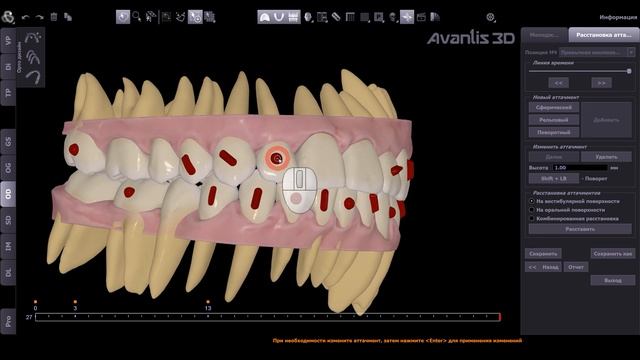 Новые возможности Avantis 3D. Орто Дизайн. Расстановка аттачментов. смотреть онлайн