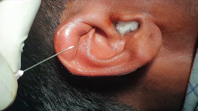 Auricular Hematoma | Treatment | Aspiration and Pressure Bandage смотреть онлайн
