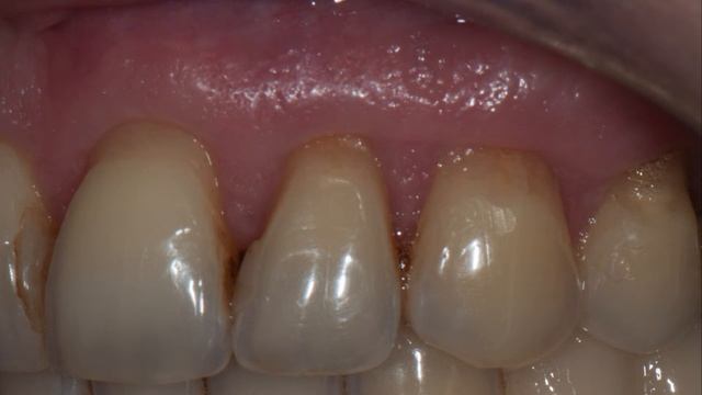 Хирургическое лечение рецессии десны 3.2 смотреть онлайн