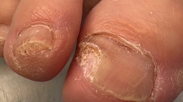 Пустота под ногтем / Отчего пустота под ногтем? / Гематома на ногте, что делать? #гематома #ноготь смотреть онлайн