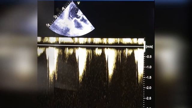 13. ГКМП до и после пробы Вальсальвы. смотреть онлайн