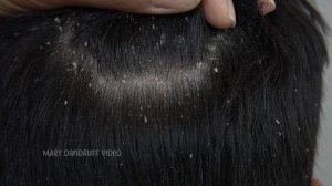 Почесывание огромных чешуек перхоти #886