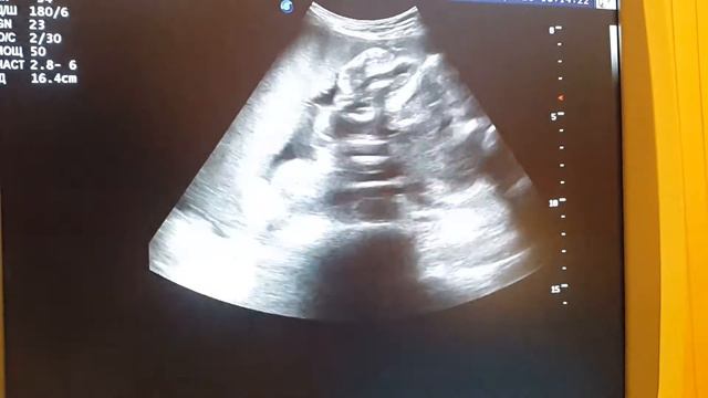 Гастрошизис, плод 32 недели(3) смотреть онлайн