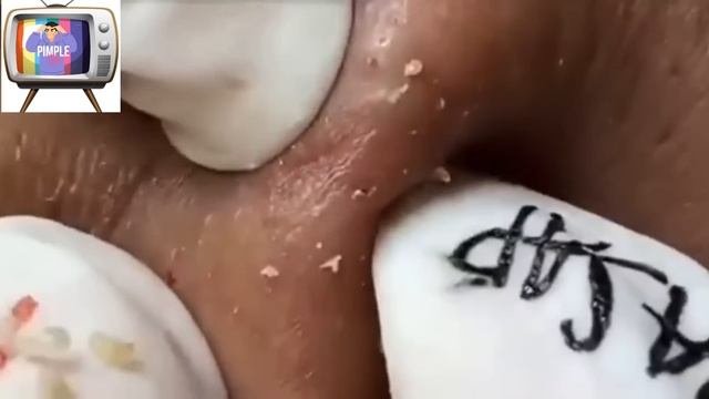 #blackheads #whiteheads #acne #relax #acneremoval #relaxing #sacdep