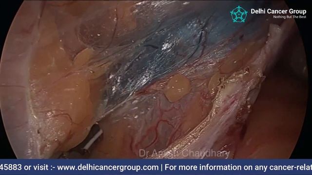 Laparoscopic Sentinel Lymph Node Biopsy in CA Endometrium смотреть онлайн