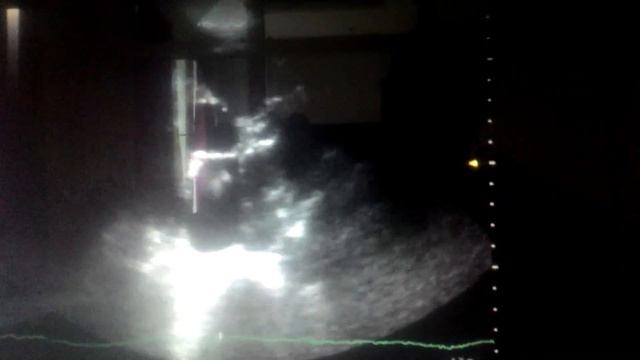 Тромб ЛП (парастернальная позиция) смотреть онлайн