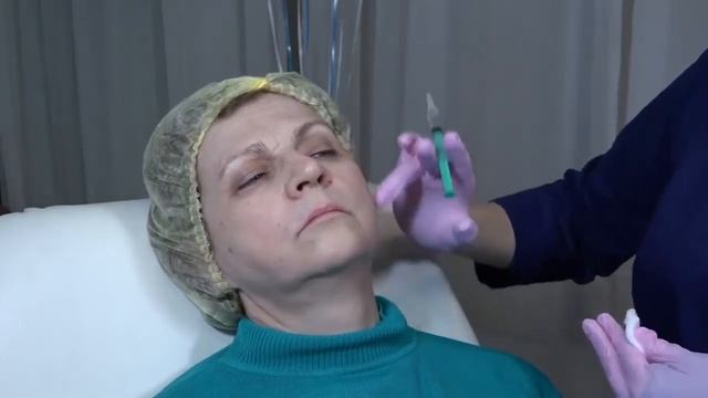 3G In-Volume ELDERMAFILL. Протокол работы препаратом