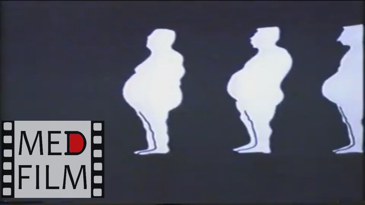 Пиквикский синдром © Pickwick Syndrom