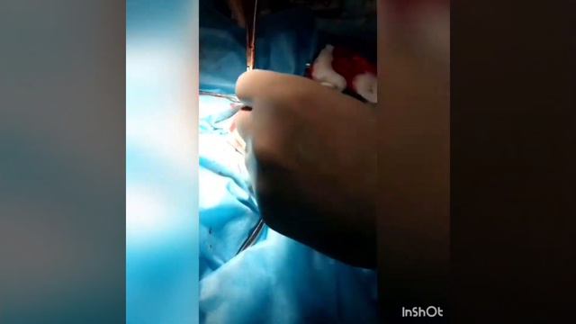 Иссечение грудной железы смотреть онлайн