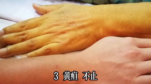 【乐厨怡妈】 45歲男子每天大便兩三次，確診胰腺癌！醫生提醒：5種异常或是身體警報，一定要重視 。 смотреть онлайн