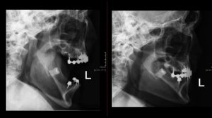 Укладка височно нижнечелюстного сустава