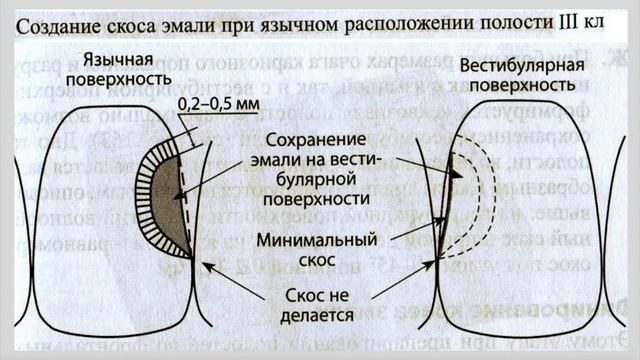 Одонтопрепарирование 2-3-4-5-6 классов смотреть онлайн