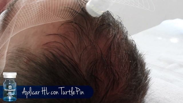 Dermaheal HL (Hair Loss) Sesion Completa Con Turtlepin (Turtle Pin)
